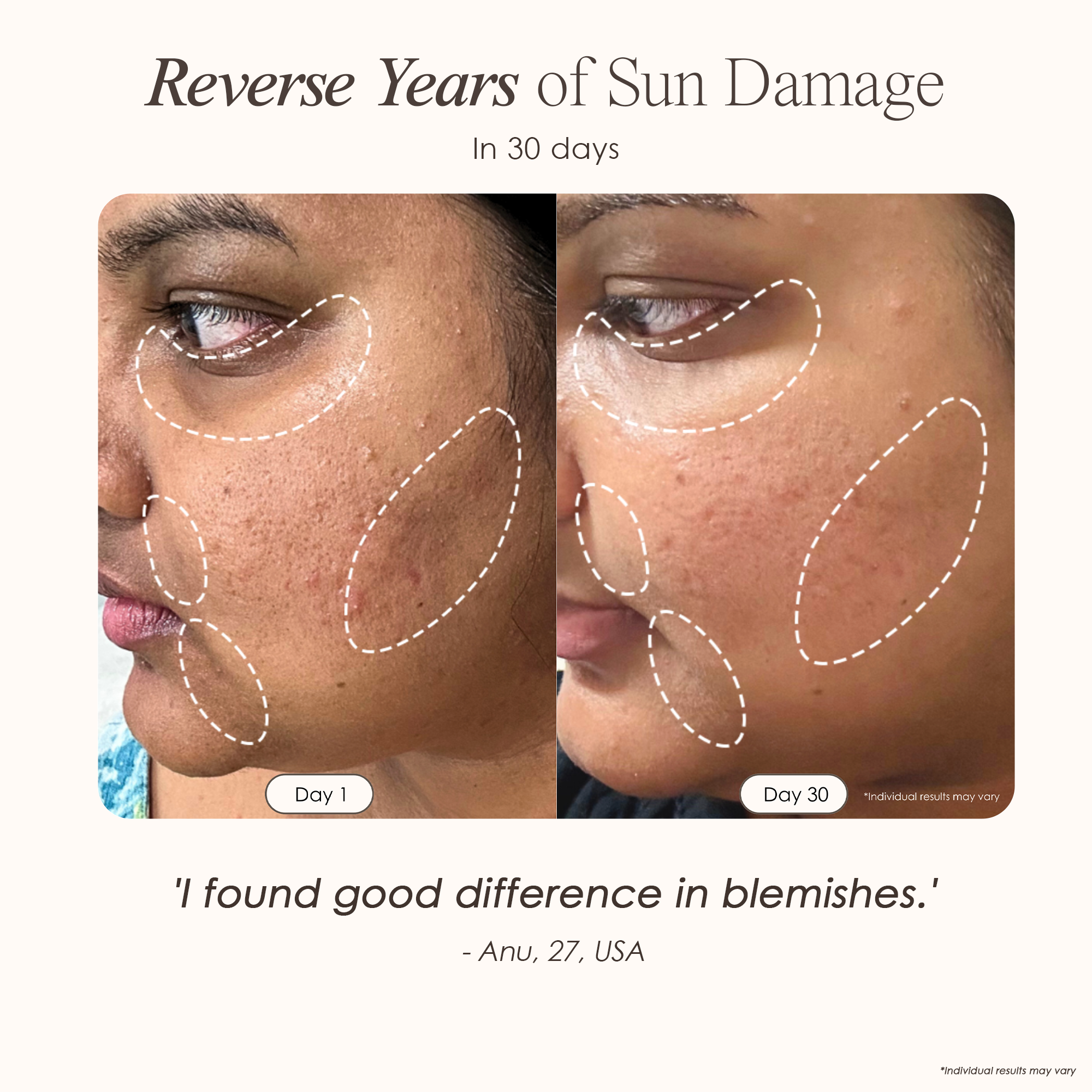 visible results after 30 days of using the LED light therapy mask