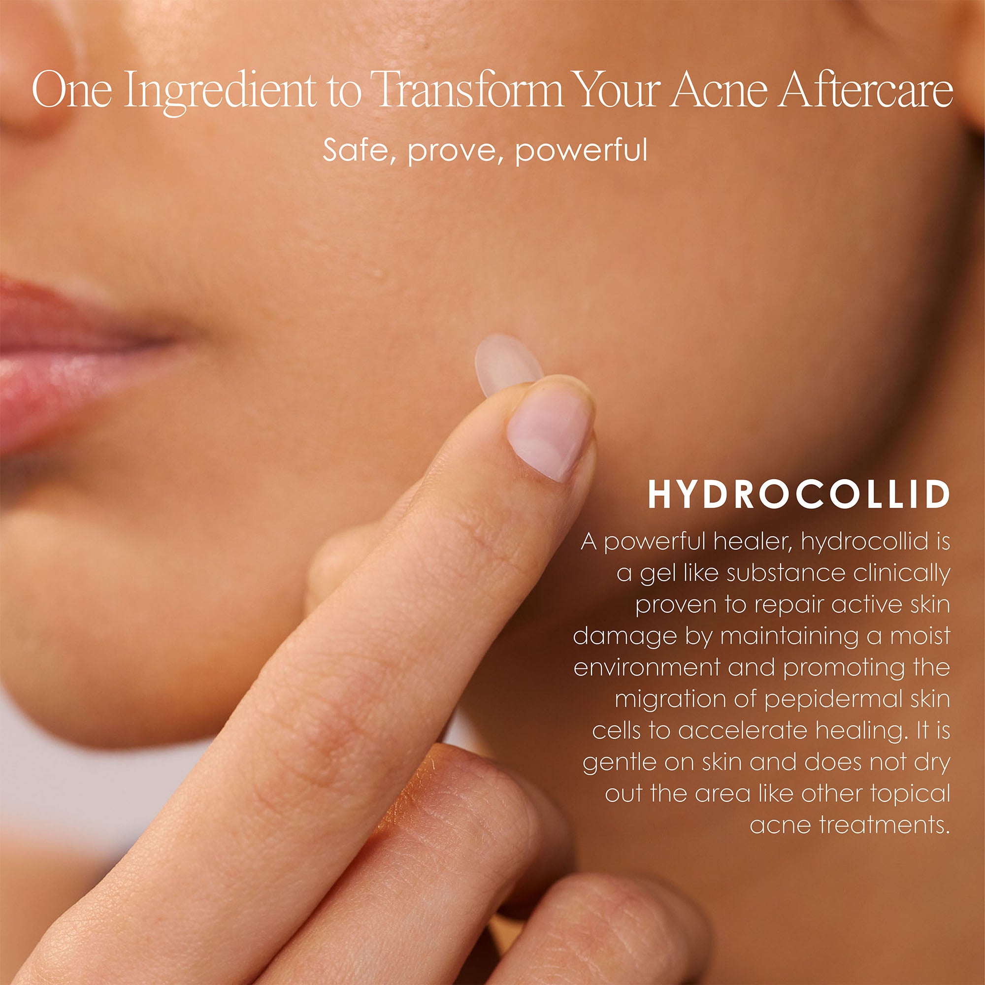 One ingredient to transform your acne aftercare