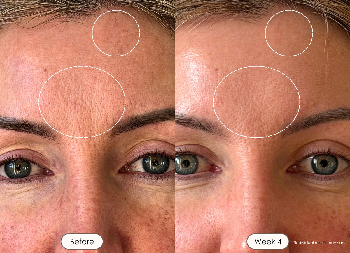 Week 4 results: reduced forehead wrinkles and improved skin texture from LED therapy.