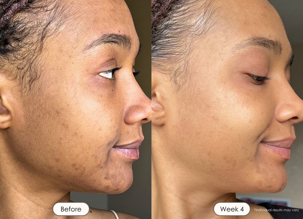 Visible skincare improvement with smoother, more radiant, and even-looking skin after using Lumalux Face mask.